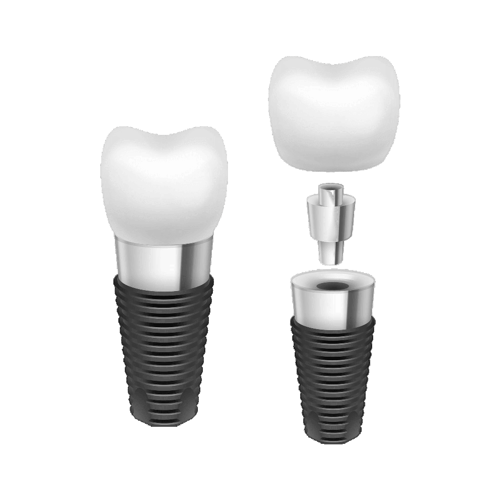 Dental Implant Transparent Picture