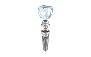 Dental Implant PNG